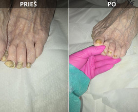 Probleminių nagų, padų, nuospaudų,varkymas jūsų namuose / Aida / Darbų pavyzdys ID 3664761