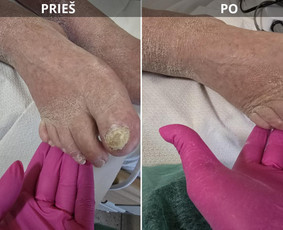 Probleminių nagų, padų, nuospaudų,varkymas jūsų namuose / Aida / Darbų pavyzdys ID 3664763