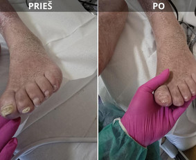 Probleminių nagų, padų, nuospaudų,varkymas jūsų namuose / Aida / Darbų pavyzdys ID 3664765