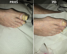 Probleminių nagų, padų, nuospaudų,varkymas jūsų namuose / Aida / Darbų pavyzdys ID 3664767