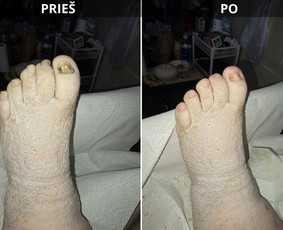 Probleminių nagų, padų, nuospaudų,varkymas jūsų namuose / Aida / Darbų pavyzdys ID 3679863