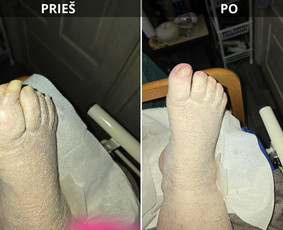 Probleminių nagų, padų, nuospaudų,varkymas jūsų namuose / Aida / Darbų pavyzdys ID 3679867