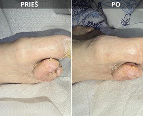 Probleminių nagų, padų, nuospaudų,varkymas jūsų namuose / Aida / Darbų pavyzdys ID 3679869