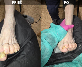 Probleminių nagų, padų, nuospaudų,varkymas jūsų namuose / Aida / Darbų pavyzdys ID 3679873
