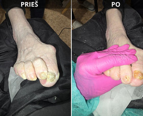 Probleminių nagų, padų, nuospaudų,varkymas jūsų namuose / Aida / Darbų pavyzdys ID 3679917