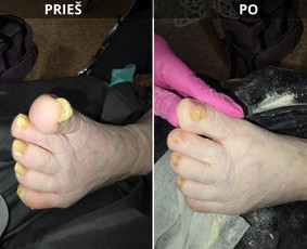 Probleminių nagų, padų, nuospaudų,varkymas jūsų namuose / Aida / Darbų pavyzdys ID 3679953