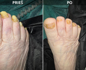 Probleminių nagų, padų, nuospaudų,varkymas jūsų namuose / Aida / Darbų pavyzdys ID 3679955
