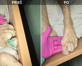 Probleminių nagų, padų, nuospaudų,varkymas jūsų namuose / Aida / Darbų pavyzdys ID 3680021