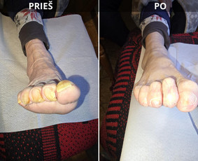 Probleminių nagų, padų, nuospaudų,varkymas jūsų namuose / Aida / Darbų pavyzdys ID 3680037