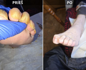 Probleminių nagų, padų, nuospaudų,varkymas jūsų namuose / Aida / Darbų pavyzdys ID 3680039