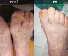Probleminių nagų, padų, nuospaudų,varkymas jūsų namuose / Aida / Darbų pavyzdys ID 3680047