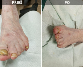 Probleminių nagų, padų, nuospaudų,varkymas jūsų namuose / Aida / Darbų pavyzdys ID 3680051