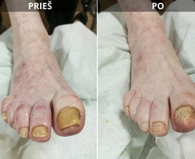 Probleminių nagų, padų, nuospaudų,varkymas jūsų namuose / Aida / Darbų pavyzdys ID 3680053