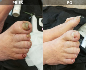 Probleminių nagų, padų, nuospaudų,varkymas jūsų namuose / Aida / Darbų pavyzdys ID 3680063