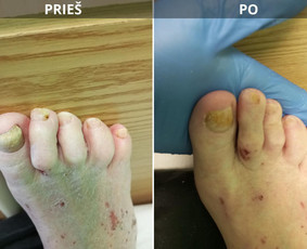 Probleminių nagų, padų, nuospaudų,varkymas jūsų namuose / Aida / Darbų pavyzdys ID 3680079