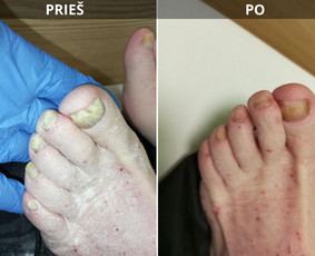 Probleminių nagų, padų, nuospaudų,varkymas jūsų namuose / Aida / Darbų pavyzdys ID 3680081