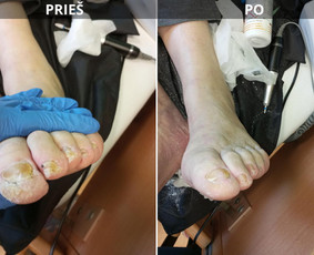 Probleminių nagų, padų, nuospaudų,varkymas jūsų namuose / Aida / Darbų pavyzdys ID 3680083