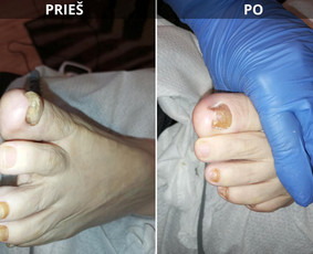 Probleminių nagų, padų, nuospaudų,varkymas jūsų namuose / Aida / Darbų pavyzdys ID 3680085