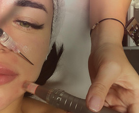 Beadatinė mezoterapija - Gilė-kosmetologijos Spa - 1