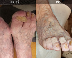 Probleminių nagų, padų, nuospaudų,varkymas jūsų namuose / Aida / Darbų pavyzdys ID 3726229
