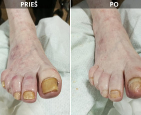 Probleminių nagų, padų, nuospaudų,varkymas jūsų namuose / Aida / Darbų pavyzdys ID 3726231