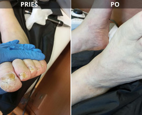 Probleminių nagų, padų, nuospaudų,varkymas jūsų namuose / Aida / Darbų pavyzdys ID 3726235
