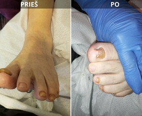 Probleminių nagų, padų, nuospaudų,varkymas jūsų namuose / Aida / Darbų pavyzdys ID 3726237