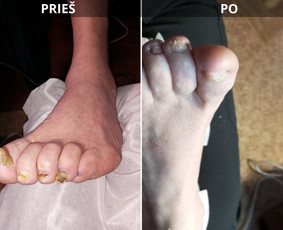 Probleminių nagų, padų, nuospaudų,varkymas jūsų namuose / Aida / Darbų pavyzdys ID 3726239