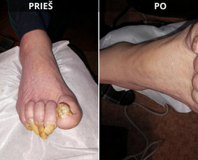 Probleminių nagų, padų, nuospaudų,varkymas jūsų namuose / Aida / Darbų pavyzdys ID 3726241