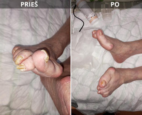 Probleminių nagų, padų, nuospaudų,varkymas jūsų namuose / Aida / Darbų pavyzdys ID 3726243