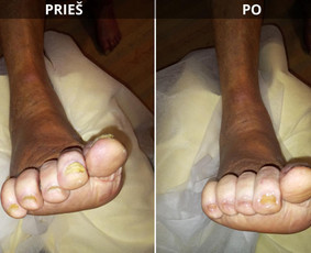 Probleminių nagų, padų, nuospaudų,varkymas jūsų namuose / Aida / Darbų pavyzdys ID 3726245