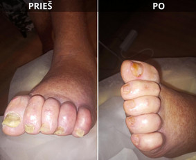 Probleminių nagų, padų, nuospaudų,varkymas jūsų namuose / Aida / Darbų pavyzdys ID 3726247