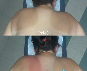 Trigerinių taškų masažas - Masažas - 3