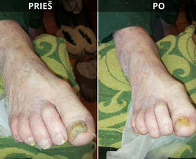 Probleminių nagų, padų, nuospaudų,varkymas jūsų namuose / Aida / Darbų pavyzdys ID 3752191