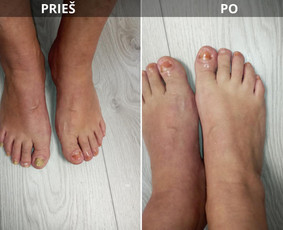Probleminių nagų, padų, nuospaudų,varkymas jūsų namuose / Aida / Darbų pavyzdys ID 3752193