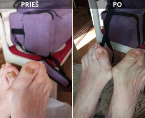 Probleminių nagų, padų, nuospaudų,varkymas jūsų namuose / Aida / Darbų pavyzdys ID 3752195