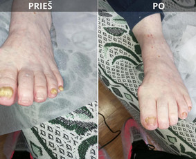 Probleminių nagų, padų, nuospaudų,varkymas jūsų namuose / Aida / Darbų pavyzdys ID 3752197
