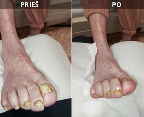 Probleminių nagų, padų, nuospaudų,varkymas jūsų namuose / Aida / Darbų pavyzdys ID 3752199