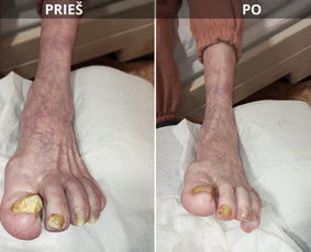 Probleminių nagų, padų, nuospaudų,varkymas jūsų namuose / Aida / Darbų pavyzdys ID 3752201
