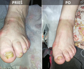 Probleminių nagų, padų, nuospaudų,varkymas jūsų namuose / Aida / Darbų pavyzdys ID 3752203