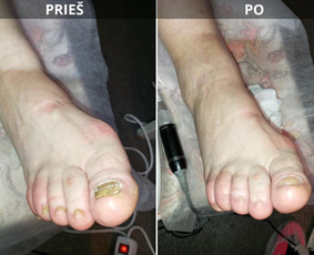 Probleminių nagų, padų, nuospaudų,varkymas jūsų namuose / Aida / Darbų pavyzdys ID 3752205