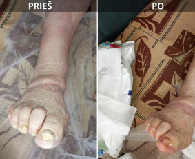 Probleminių nagų, padų, nuospaudų,varkymas jūsų namuose / Aida / Darbų pavyzdys ID 3752207