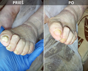 Probleminių nagų, padų, nuospaudų,varkymas jūsų namuose / Aida / Darbų pavyzdys ID 3752209
