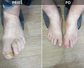 Probleminių nagų, padų, nuospaudų,varkymas jūsų namuose / Aida / Darbų pavyzdys ID 3752211