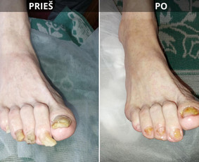 Probleminių nagų, padų, nuospaudų,varkymas jūsų namuose / Aida / Darbų pavyzdys ID 3752213