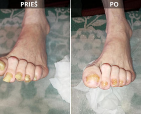 Probleminių nagų, padų, nuospaudų,varkymas jūsų namuose / Aida / Darbų pavyzdys ID 3752215