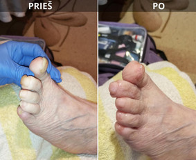 Probleminių nagų, padų, nuospaudų,varkymas jūsų namuose / Aida / Darbų pavyzdys ID 3768305
