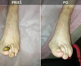 Probleminių nagų, padų, nuospaudų,varkymas jūsų namuose / Aida / Darbų pavyzdys ID 3779029