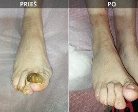 Probleminių nagų, padų, nuospaudų,varkymas jūsų namuose / Aida / Darbų pavyzdys ID 3779033