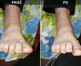 Probleminių nagų, padų, nuospaudų,varkymas jūsų namuose / Aida / Darbų pavyzdys ID 3779035